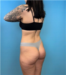 Buttock Lift with Augmentation Before Photo by Mark Markarian, MD, MSPH, FACS; Wellesley, MA - Case 49168