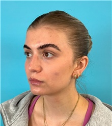 Rhinoplasty After Photo by Mark Markarian, MD, MSPH, FACS; Wellesley, MA - Case 49189