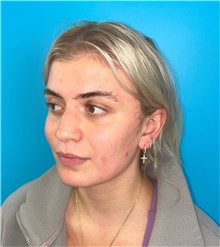 Rhinoplasty Before Photo by Mark Markarian, MD, MSPH, FACS; Wellesley, MA - Case 49189