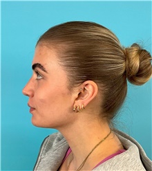 Rhinoplasty After Photo by Mark Markarian, MD, MSPH, FACS; Wellesley, MA - Case 49189