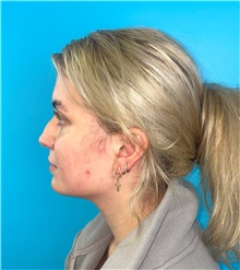 Rhinoplasty Before Photo by Mark Markarian, MD, MSPH, FACS; Wellesley, MA - Case 49189