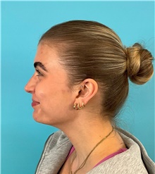 Rhinoplasty After Photo by Mark Markarian, MD, MSPH, FACS; Wellesley, MA - Case 49189