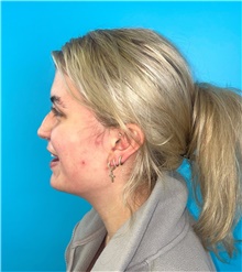 Rhinoplasty Before Photo by Mark Markarian, MD, MSPH, FACS; Wellesley, MA - Case 49189