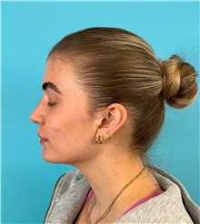 Rhinoplasty After Photo by Mark Markarian, MD, MSPH, FACS; Wellesley, MA - Case 49189