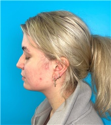 Rhinoplasty Before Photo by Mark Markarian, MD, MSPH, FACS; Wellesley, MA - Case 49189