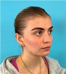 Rhinoplasty After Photo by Mark Markarian, MD, MSPH, FACS; Wellesley, MA - Case 49189