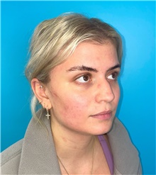 Rhinoplasty Before Photo by Mark Markarian, MD, MSPH, FACS; Wellesley, MA - Case 49189