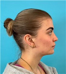 Rhinoplasty After Photo by Mark Markarian, MD, MSPH, FACS; Wellesley, MA - Case 49189