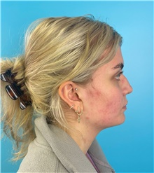 Rhinoplasty Before Photo by Mark Markarian, MD, MSPH, FACS; Wellesley, MA - Case 49189