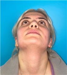 Rhinoplasty Before Photo by Mark Markarian, MD, MSPH, FACS; Wellesley, MA - Case 49189