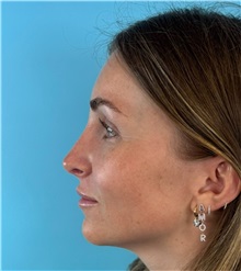Rhinoplasty After Photo by Mark Markarian, MD, MSPH, FACS; Wellesley, MA - Case 50792