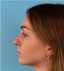 Rhinoplasty Before Photo by Mark Markarian, MD, MSPH, FACS; Wellesley, MA - Case 50792