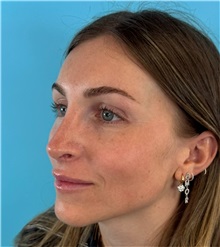 Rhinoplasty After Photo by Mark Markarian, MD, MSPH, FACS; Wellesley, MA - Case 50792