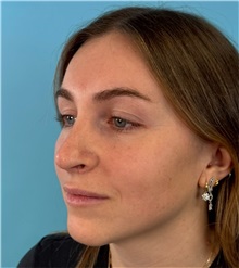 Rhinoplasty Before Photo by Mark Markarian, MD, MSPH, FACS; Wellesley, MA - Case 50792
