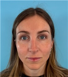 Rhinoplasty After Photo by Mark Markarian, MD, MSPH, FACS; Wellesley, MA - Case 50792