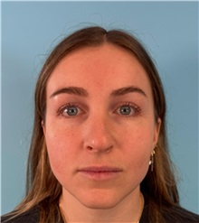 Rhinoplasty Before Photo by Mark Markarian, MD, MSPH, FACS; Wellesley, MA - Case 50792