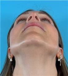 Rhinoplasty After Photo by Mark Markarian, MD, MSPH, FACS; Wellesley, MA - Case 50792