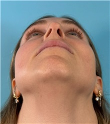 Rhinoplasty Before Photo by Mark Markarian, MD, MSPH, FACS; Wellesley, MA - Case 50792