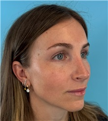Rhinoplasty After Photo by Mark Markarian, MD, MSPH, FACS; Wellesley, MA - Case 50792