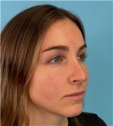Rhinoplasty Before Photo by Mark Markarian, MD, MSPH, FACS; Wellesley, MA - Case 50792