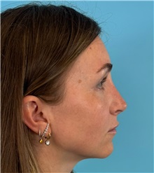 Rhinoplasty After Photo by Mark Markarian, MD, MSPH, FACS; Wellesley, MA - Case 50792