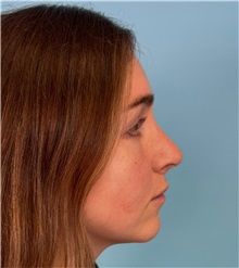 Rhinoplasty Before Photo by Mark Markarian, MD, MSPH, FACS; Wellesley, MA - Case 50792