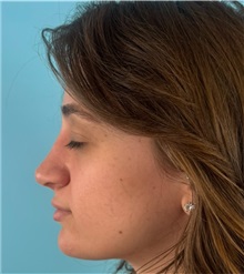 Rhinoplasty After Photo by Mark Markarian, MD, MSPH, FACS; Wellesley, MA - Case 51624