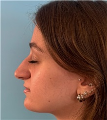 Rhinoplasty Before Photo by Mark Markarian, MD, MSPH, FACS; Wellesley, MA - Case 51624