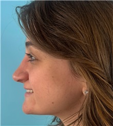 Rhinoplasty After Photo by Mark Markarian, MD, MSPH, FACS; Wellesley, MA - Case 51624