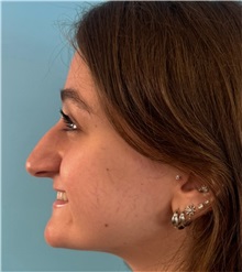 Rhinoplasty Before Photo by Mark Markarian, MD, MSPH, FACS; Wellesley, MA - Case 51624