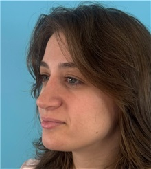 Rhinoplasty After Photo by Mark Markarian, MD, MSPH, FACS; Wellesley, MA - Case 51624