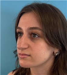 Rhinoplasty Before Photo by Mark Markarian, MD, MSPH, FACS; Wellesley, MA - Case 51624