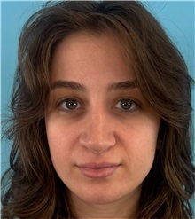 Rhinoplasty After Photo by Mark Markarian, MD, MSPH, FACS; Wellesley, MA - Case 51624