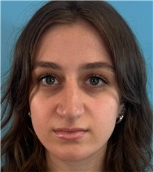 Rhinoplasty Before Photo by Mark Markarian, MD, MSPH, FACS; Wellesley, MA - Case 51624