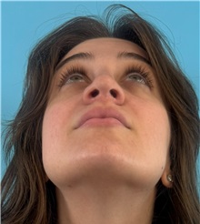 Rhinoplasty After Photo by Mark Markarian, MD, MSPH, FACS; Wellesley, MA - Case 51624