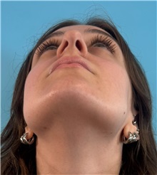 Rhinoplasty Before Photo by Mark Markarian, MD, MSPH, FACS; Wellesley, MA - Case 51624