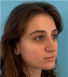 Rhinoplasty After Photo by Mark Markarian, MD, MSPH, FACS; Wellesley, MA - Case 51624