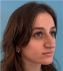 Rhinoplasty Before Photo by Mark Markarian, MD, MSPH, FACS; Wellesley, MA - Case 51624