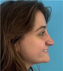 Rhinoplasty After Photo by Mark Markarian, MD, MSPH, FACS; Wellesley, MA - Case 51624