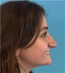 Rhinoplasty Before Photo by Mark Markarian, MD, MSPH, FACS; Wellesley, MA - Case 51624