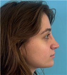 Rhinoplasty After Photo by Mark Markarian, MD, MSPH, FACS; Wellesley, MA - Case 51624