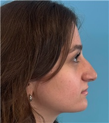Rhinoplasty Before Photo by Mark Markarian, MD, MSPH, FACS; Wellesley, MA - Case 51624