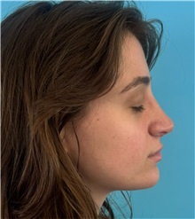Rhinoplasty After Photo by Mark Markarian, MD, MSPH, FACS; Wellesley, MA - Case 51624