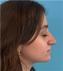 Rhinoplasty Before Photo by Mark Markarian, MD, MSPH, FACS; Wellesley, MA - Case 51624