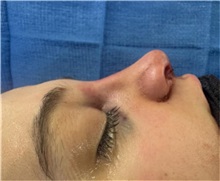 Rhinoplasty After Photo by Mark Markarian, MD, MSPH, FACS; Wellesley, MA - Case 51624