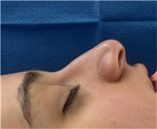 Rhinoplasty Before Photo by Mark Markarian, MD, MSPH, FACS; Wellesley, MA - Case 51624