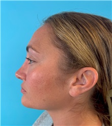 Rhinoplasty After Photo by Mark Markarian, MD, MSPH, FACS; Wellesley, MA - Case 49397