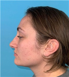 Rhinoplasty Before Photo by Mark Markarian, MD, MSPH, FACS; Wellesley, MA - Case 49397