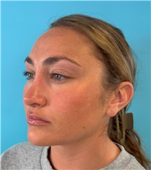 Rhinoplasty After Photo by Mark Markarian, MD, MSPH, FACS; Wellesley, MA - Case 49397