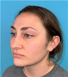 Rhinoplasty Before Photo by Mark Markarian, MD, MSPH, FACS; Wellesley, MA - Case 49397